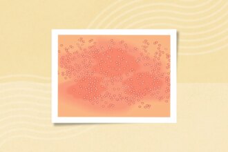 What Is Generalized Pustular Psoriasis (GPP)? Symptoms, Causes, Diagnosis, Treatment, and Prevention