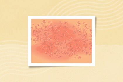 What Is Generalized Pustular Psoriasis (GPP)? Symptoms, Causes, Diagnosis, Treatment, and Prevention