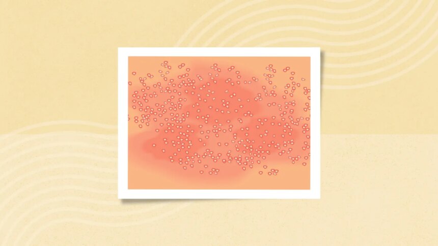 What Is Generalized Pustular Psoriasis (GPP)? Symptoms, Causes, Diagnosis, Treatment, and Prevention
