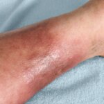 Cellulitis Symptoms