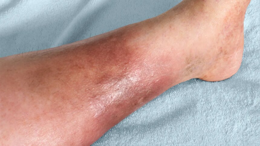 Cellulitis Symptoms