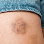 Does Diabetes Make You Bruise Easily?