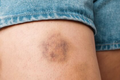Does Diabetes Make You Bruise Easily?