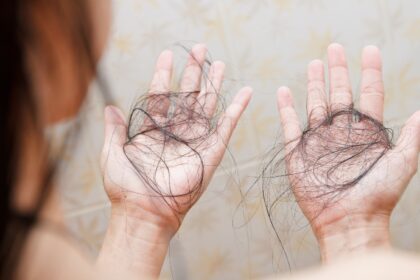 International Alopecia Day 2025: Cosmetic surgeon explains why autoimmune hair loss is rising
