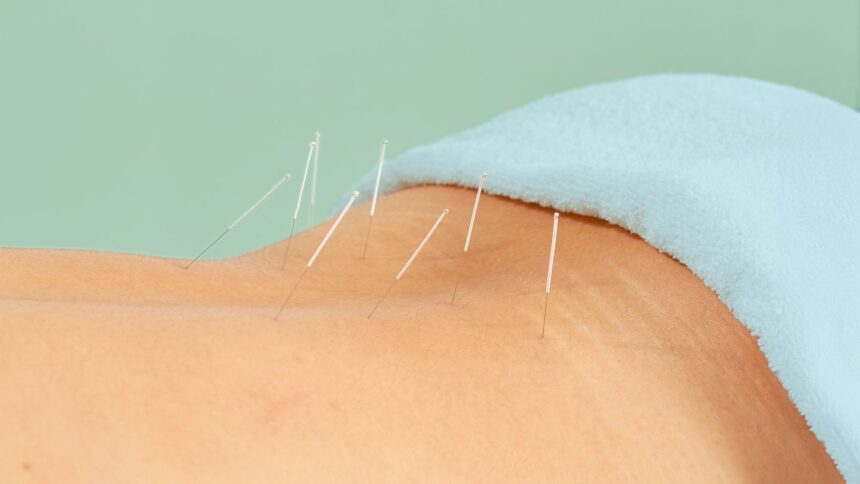Acupuncture May Ease Chronic Low Back Pain Better Than Drugs