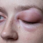 Hereditary Angioedema Symptoms