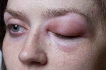 Hereditary Angioedema Symptoms