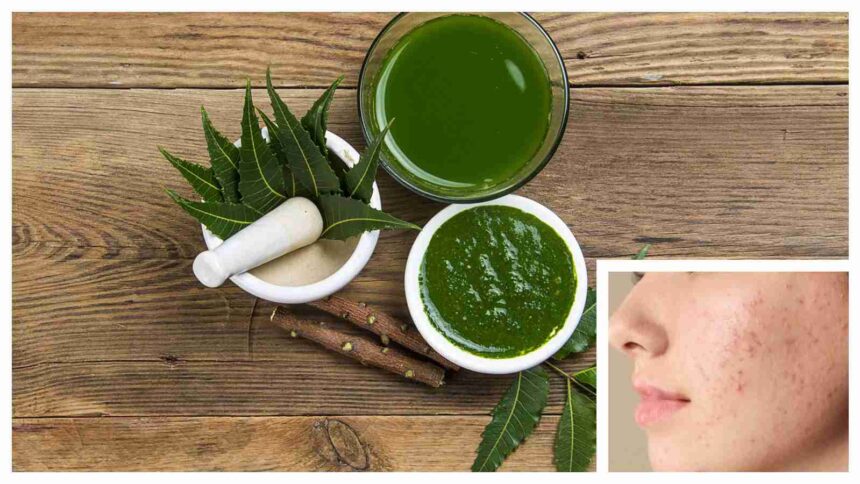 How to use neem to reduce acne and pimples without wrecking your skin