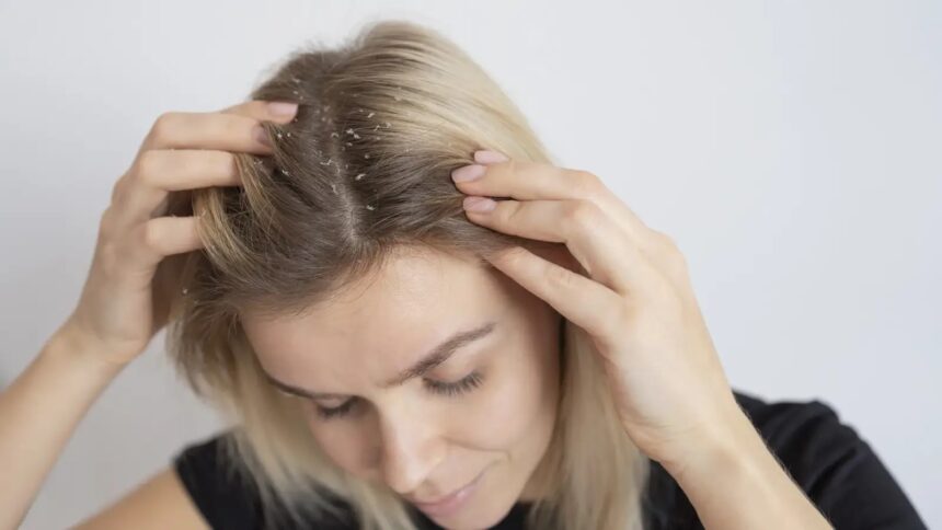 Tired of oily and sticky dandruff? Here are 6 quick fixes you need