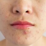 5 skincare hacks to fight acne when the season changes