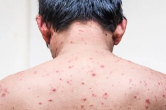 Chickenpox in Adults: Risk Factors, Symptoms, Complications, Treatment
