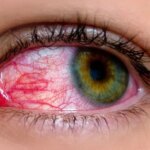 8 Common Myths About Pink Eye