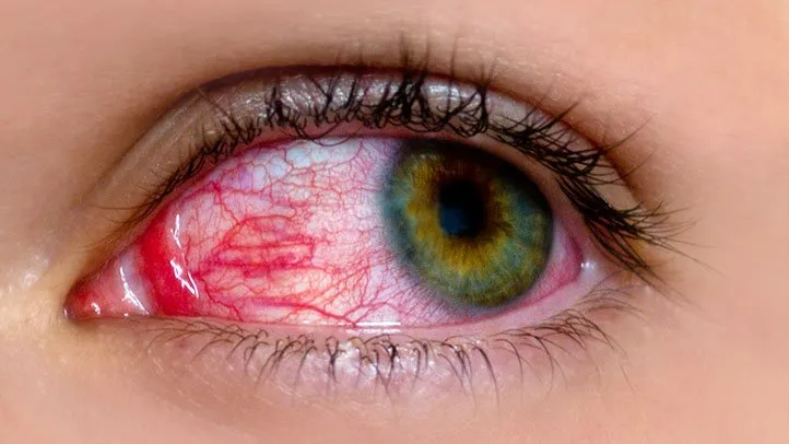 8 Common Myths About Pink Eye