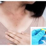 Dark patches on your child’s neck? Doctor says it may be a sign of insulin resistance