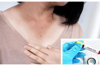 Dark patches on your child’s neck? Doctor says it may be a sign of insulin resistance