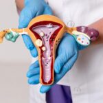 Can PCOS increase your diabetes risk? Here’s what every woman should know