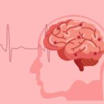 6 major causes of stroke in young adults, according to a cardiologist