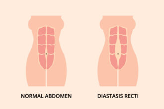 split abs after birth