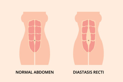 split abs after birth