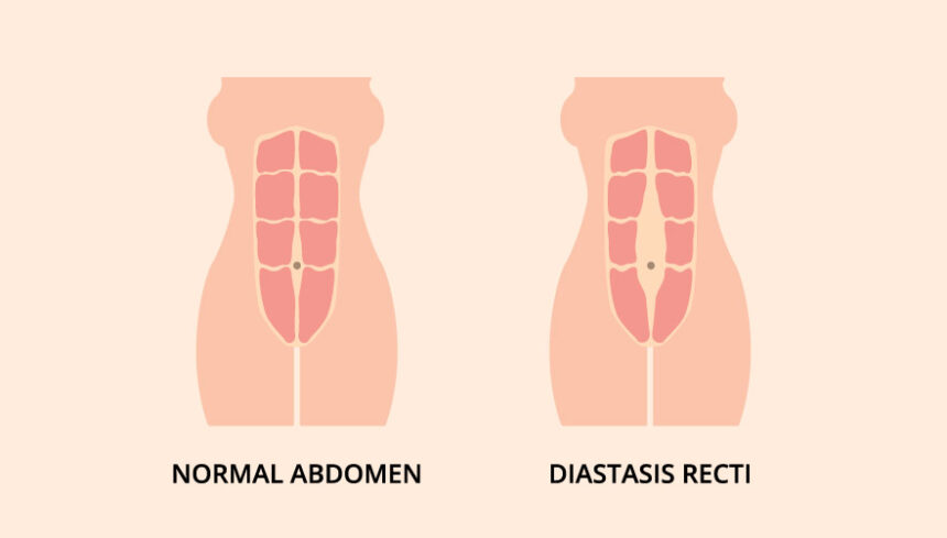 split abs after birth