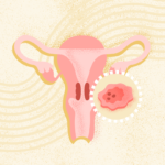 What Is Cervical Cancer? Symptoms, Causes, Treatment, and Prevention