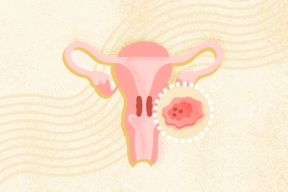 What Is Cervical Cancer? Symptoms, Causes, Treatment, and Prevention