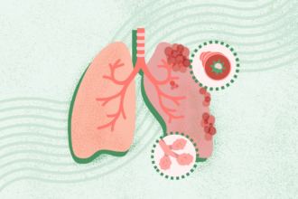 What Is COPD? Symptoms, Causes, Diagnosis, Treatment, and Prevention