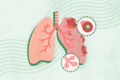 What Is COPD? Symptoms, Causes, Diagnosis, Treatment, and Prevention