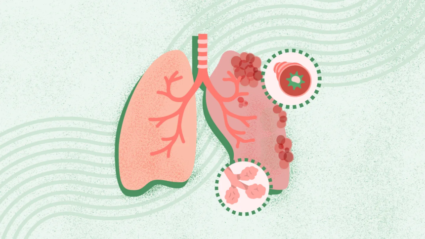 What Is COPD? Symptoms, Causes, Diagnosis, Treatment, and Prevention