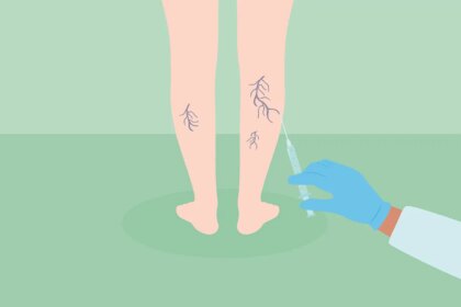 What Is Sclerotherapy for Spider Veins and Varicose Veins?
