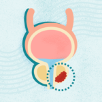 What Is Prostate Cancer? Symptoms, Stages, Diagnosis, Treatment, and More