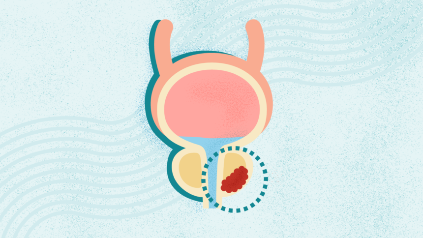 What Is Prostate Cancer? Symptoms, Stages, Diagnosis, Treatment, and More