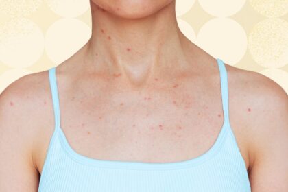 5 Places Body Acne Can Show Up and What to Do About It