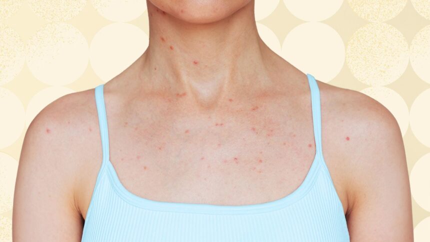 5 Places Body Acne Can Show Up and What to Do About It