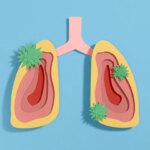 Severe Flu or COVID-19 Could Raise Lung Cancer Risk