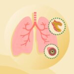 What Is Bronchiectasis?