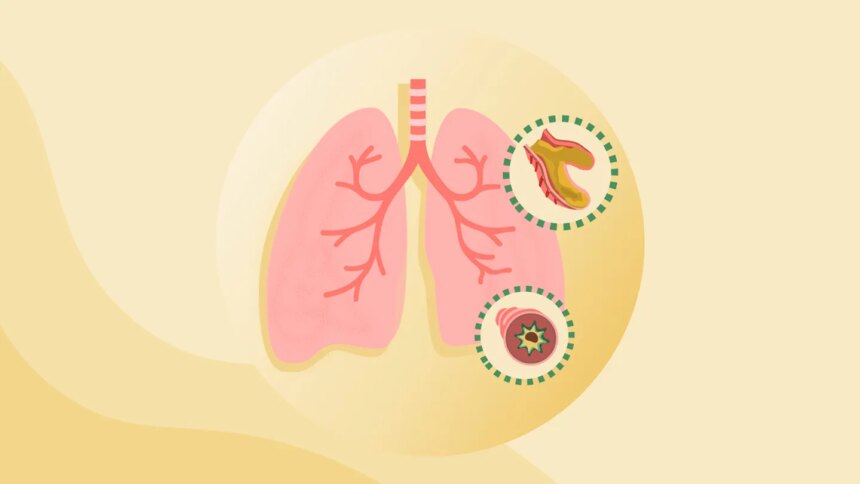What Is Bronchiectasis?
