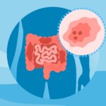 What Is Early-Onset Colorectal Cancer?