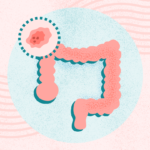 What Is Colon and Rectal Cancer? Symptoms, Causes, Diagnosis, Treatment, and Prevention