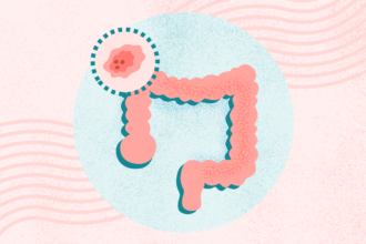 What Is Colon and Rectal Cancer? Symptoms, Causes, Diagnosis, Treatment, and Prevention