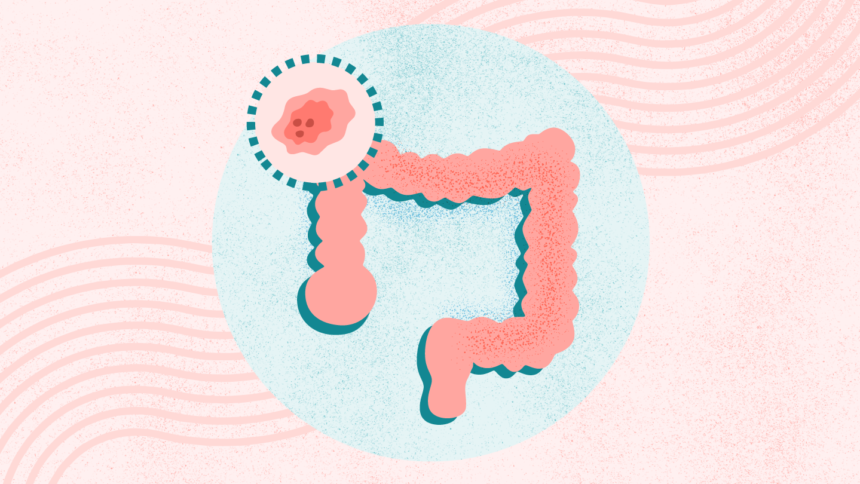 What Is Colon and Rectal Cancer? Symptoms, Causes, Diagnosis, Treatment, and Prevention