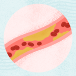 What Is High Cholesterol?