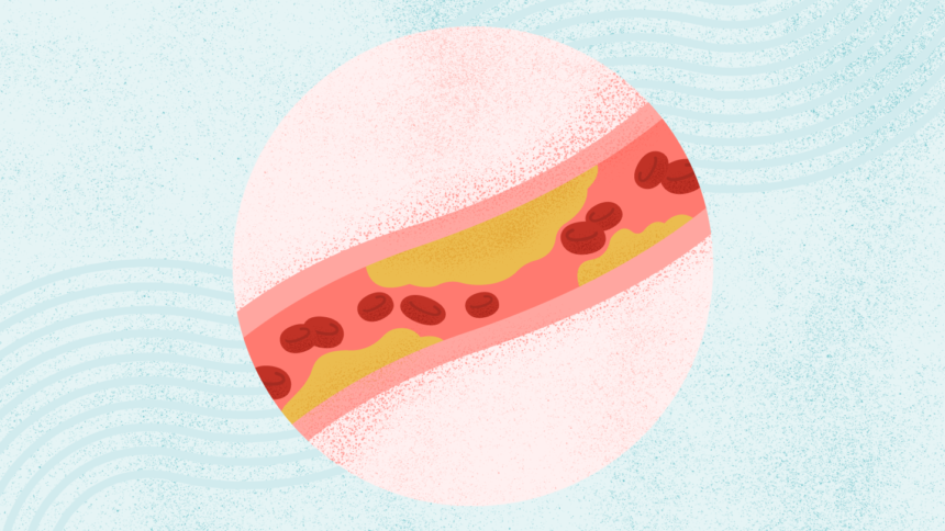 What Is High Cholesterol?