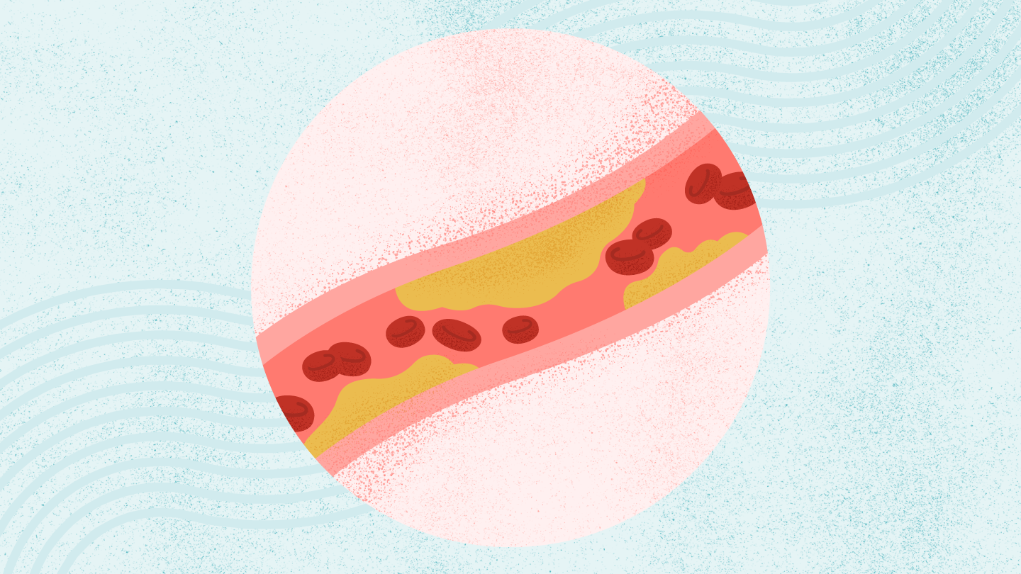 What Is High Cholesterol?