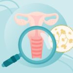What Is a Yeast Infection? Symptoms, Causes, Diagnosis, Treatment, and Prevention
