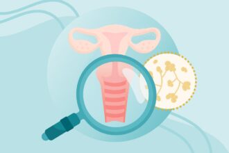 What Is a Yeast Infection? Symptoms, Causes, Diagnosis, Treatment, and Prevention