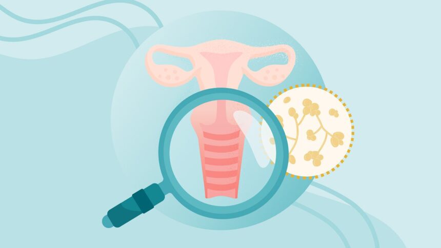 What Is a Yeast Infection? Symptoms, Causes, Diagnosis, Treatment, and Prevention