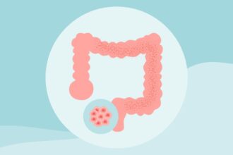 8 Myths About Colon Cancer Debunked