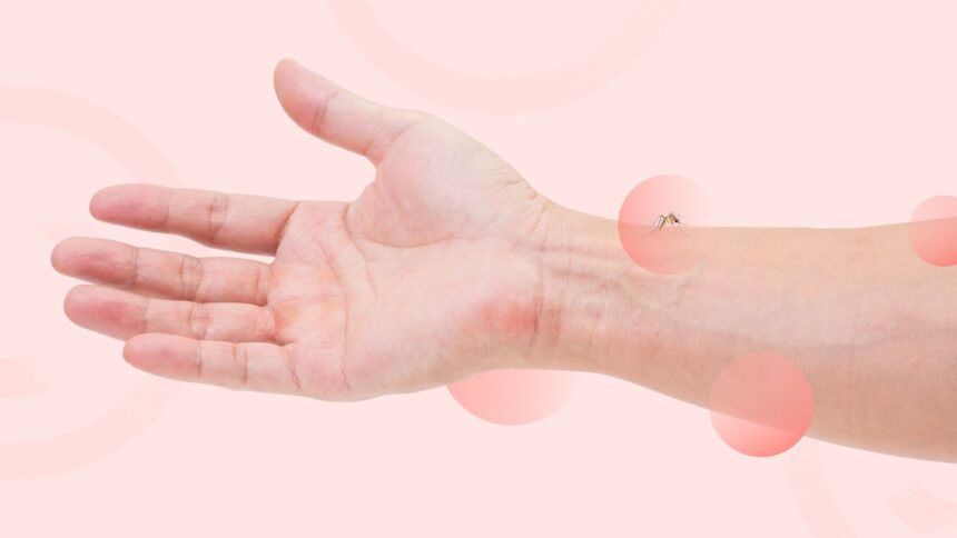 Are You a Mosquito Magnet? Here’s Why and What to Do About It