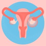 What Is Polyendocrine Metabolic Ovarian Syndrome (PMOS), Formerly Known as PCOS?